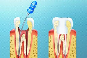 Пломбирование зубов — виды материалов, установки