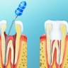 Пломбирование зубов — виды материалов, установки
